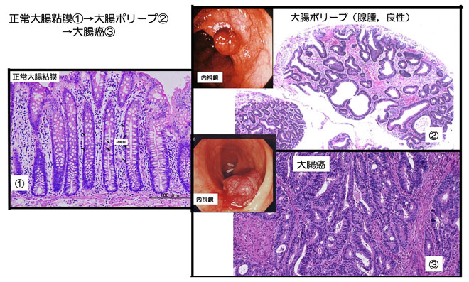 図６　大腸正常粘膜、大腸ポリープ、大腸癌のミクロ