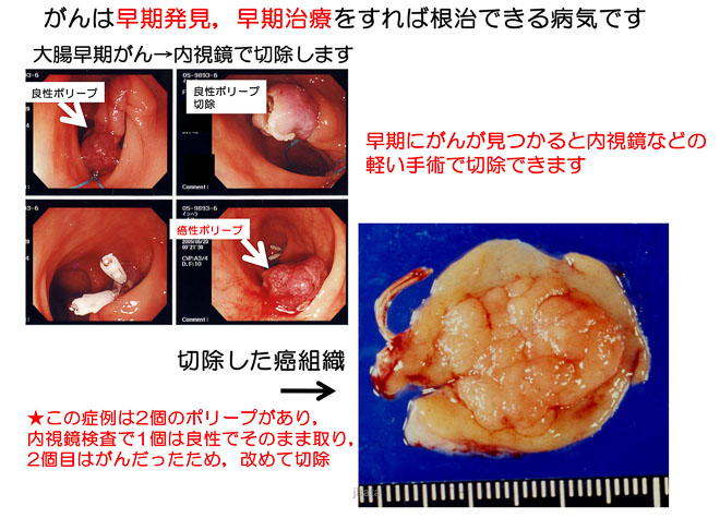 図８　早期大腸癌の大腸鏡（内視鏡）手術