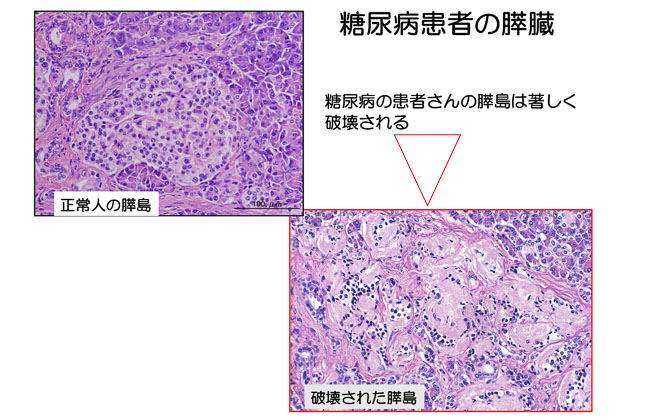 図１１　糖尿病患者の膵島