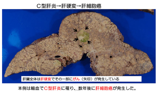 図１１　C型肝炎ウイルスによる広汎な肝硬変、一部に肝細胞癌が発生