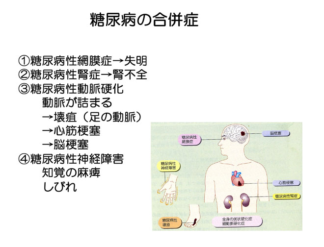図1２ 糖尿病の合併症