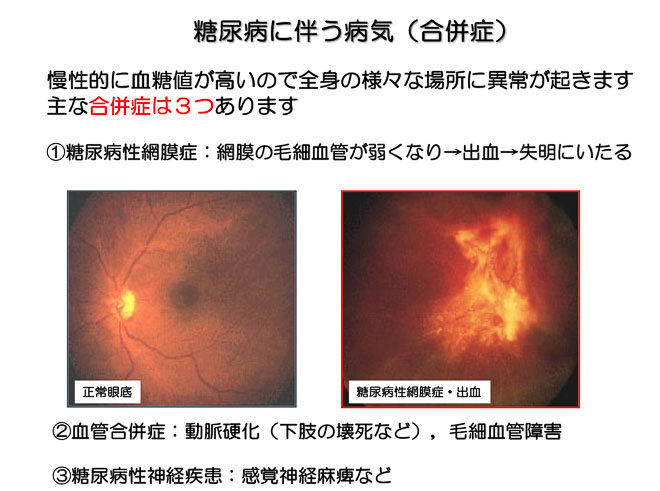 図１３　糖尿病性網膜症