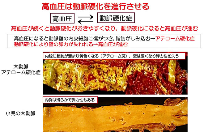 図１４　高血圧と動脈硬化は強く関連する