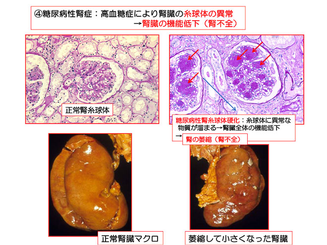 図１４　糖尿性腎症（ミクロ）