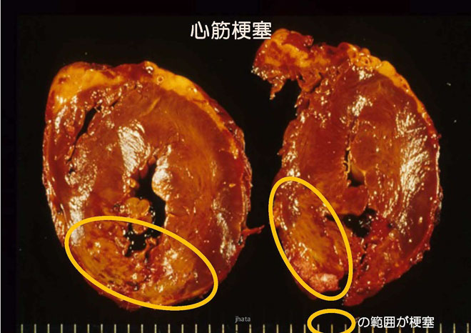 図１６　心筋梗塞　壊死を起こし、心筋が黄色く見える。心臓を輪切りにした図