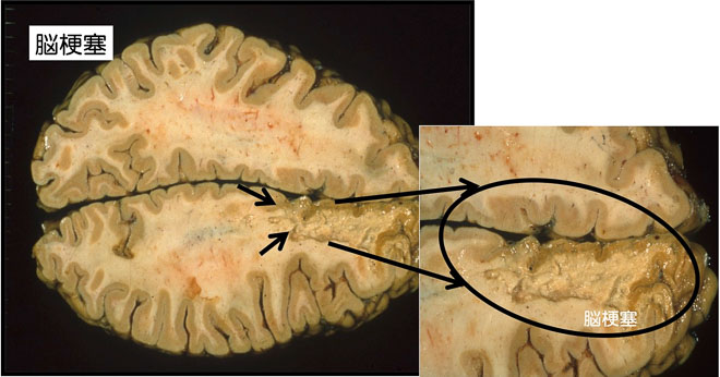 図１７　脳梗塞　壊死を起こした大脳が融けたように見えるので脳軟化ともいう