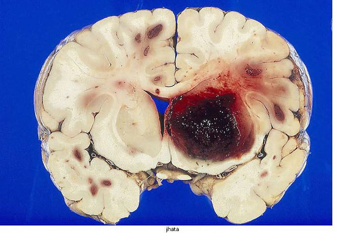 図１８　大脳出血