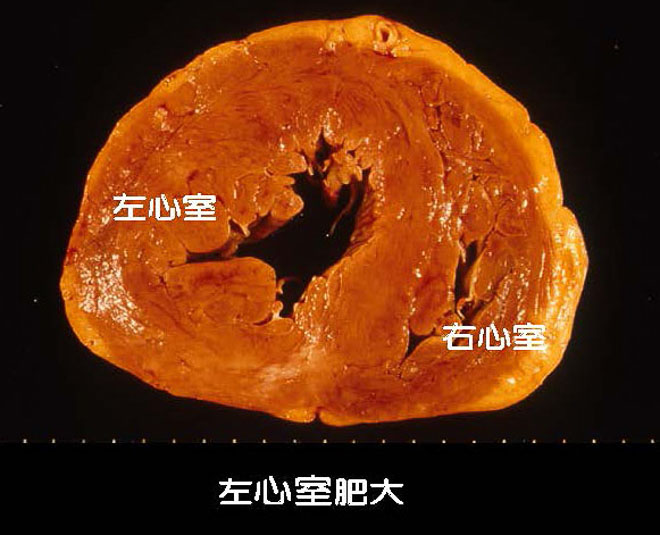 図１９　高血圧症による左心室肥大、心臓の輪切り標本