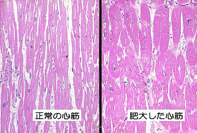 図２１　心筋細胞の肥大（右）（正常心筋・左との比較）