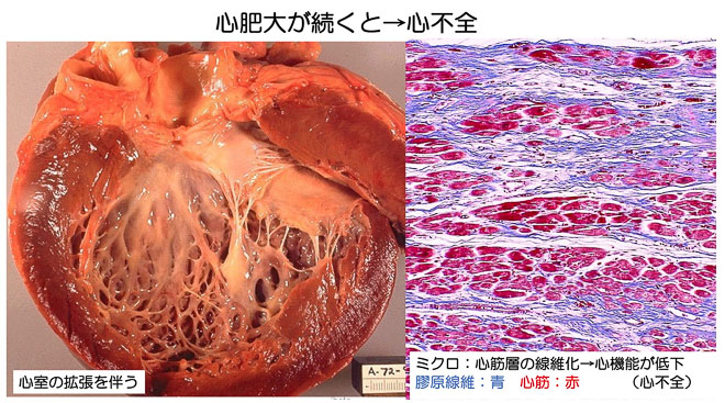 図２２　拡張性肥大を示した心臓のマクロとミクロ