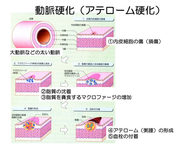 図２２　動脈硬化症の成り立ち