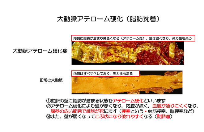 図２３　大動脈アテロ−ム硬化症（大動脈縦切開、マクロ）