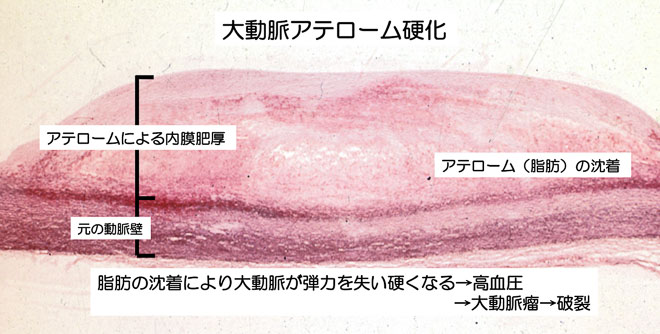 図２４　大動脈アテローム硬化による内膜への脂肪沈着