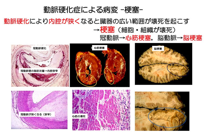 図２７　動脈硬化性狭窄による心筋梗塞と脳梗塞